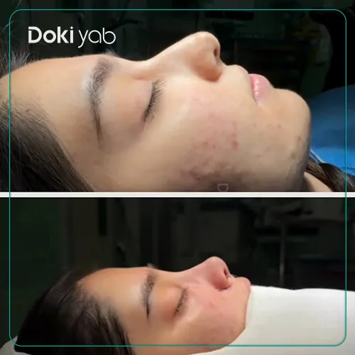 عکس نمونه کار جراحی بینی با دکتر آرش سبحان منش در شیراز