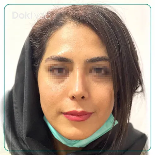جراحی بینی توسط دکتر آرش سبحان منش در شیراز