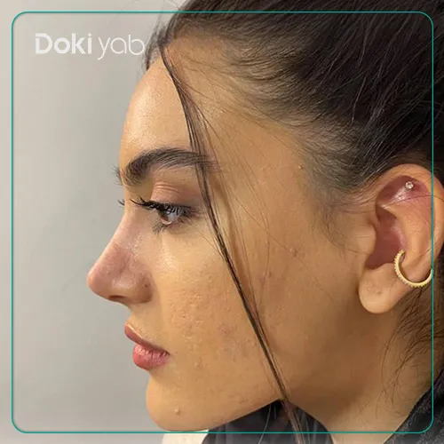 نمونه کار جراحی بینی دکتر آرش سبحان منش در شیراز