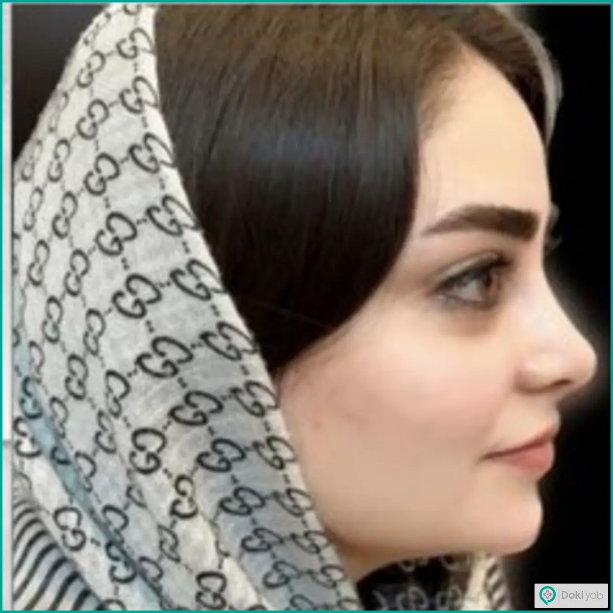 نمونه عمل بینی طبیعی دکتر لیلا اسدپور جراح بینی شیراز
