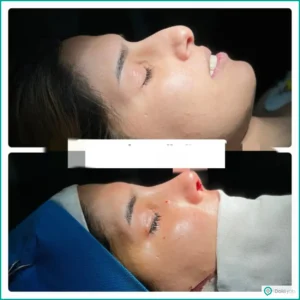 تصویر قبل و بعد عمل بینی استخوانی نیمه فانتزی دکتر محمد بلاغی در شیراز