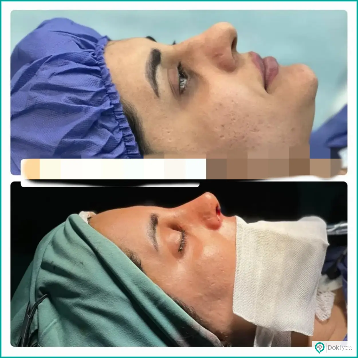 تصویر قبل و بعد عمل بینی نیمه فانتزی دکتر محمد بلاغی جراح بینی شیراز