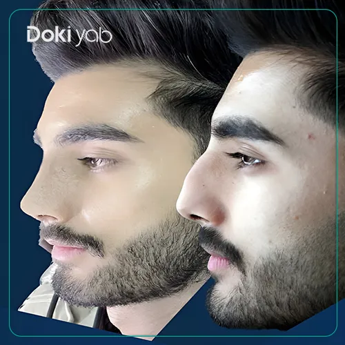 عکس قبل و بعد عمل بینی فانتزی دکتر شقایق ابراهیم نژاد
