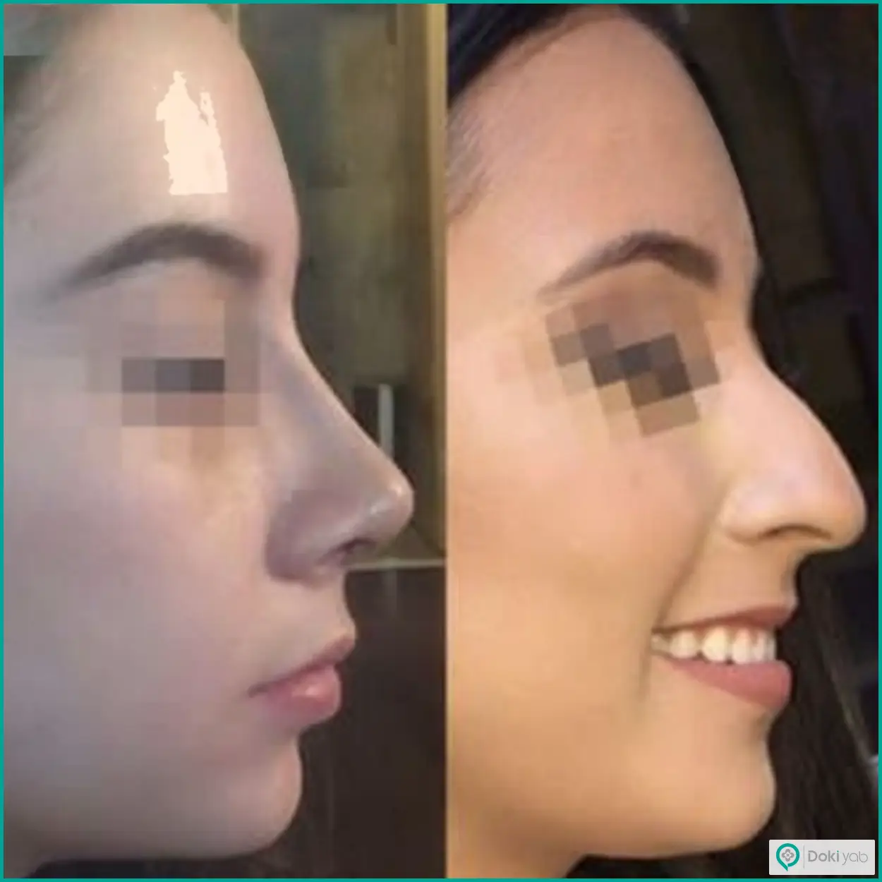 عکس قبل و بعد عمل بینی طبیعی دکتر وحید عین آبادی جراح بینی در شیراز