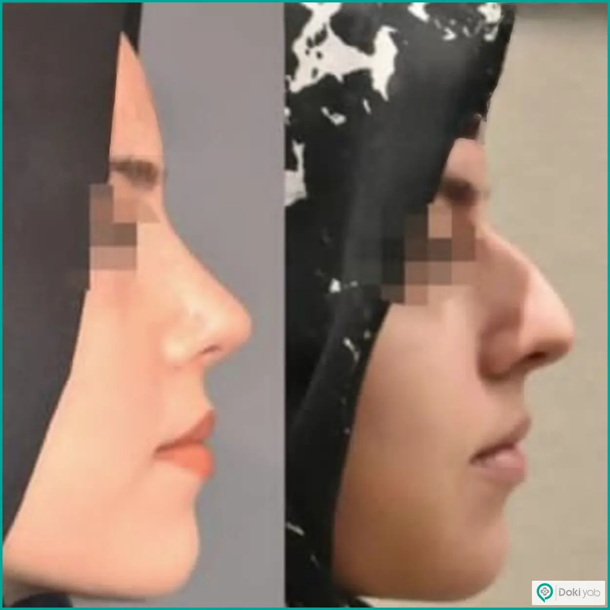 عکس قبل و بعد جراحی بینی استخوانی به سبک نیمه فانتزی دکتر وحید عین آبادی جراح بینی در شیراز