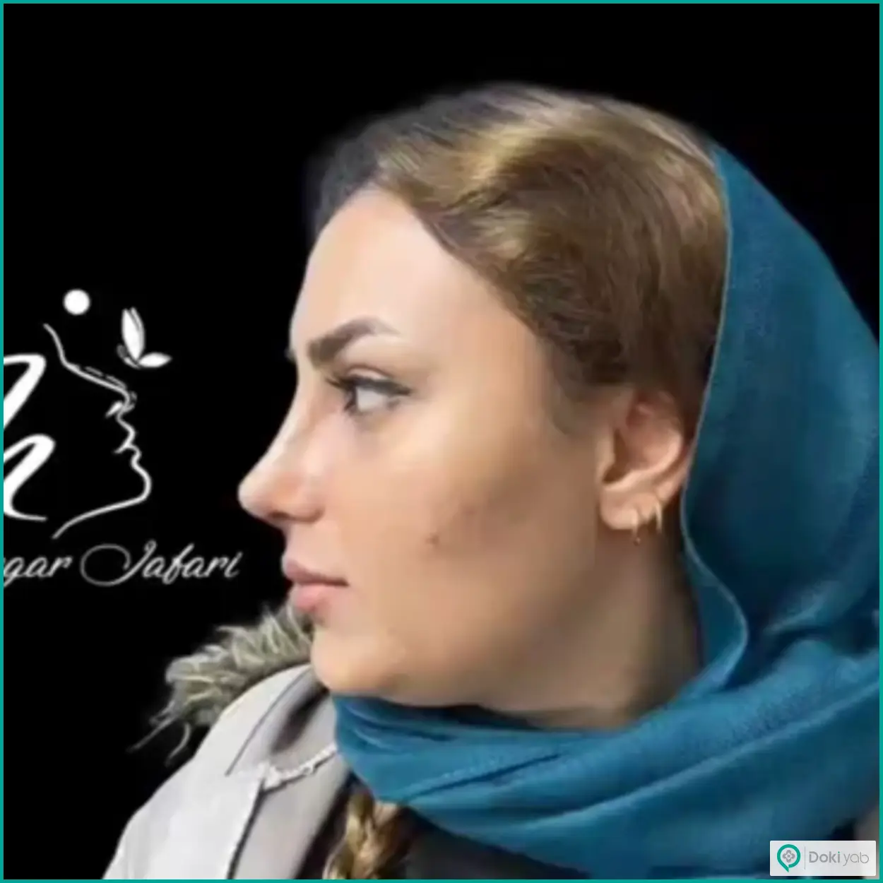 نمونه عمل بینی طبیعی دکتر نگار جعفری جراح بینی شیراز