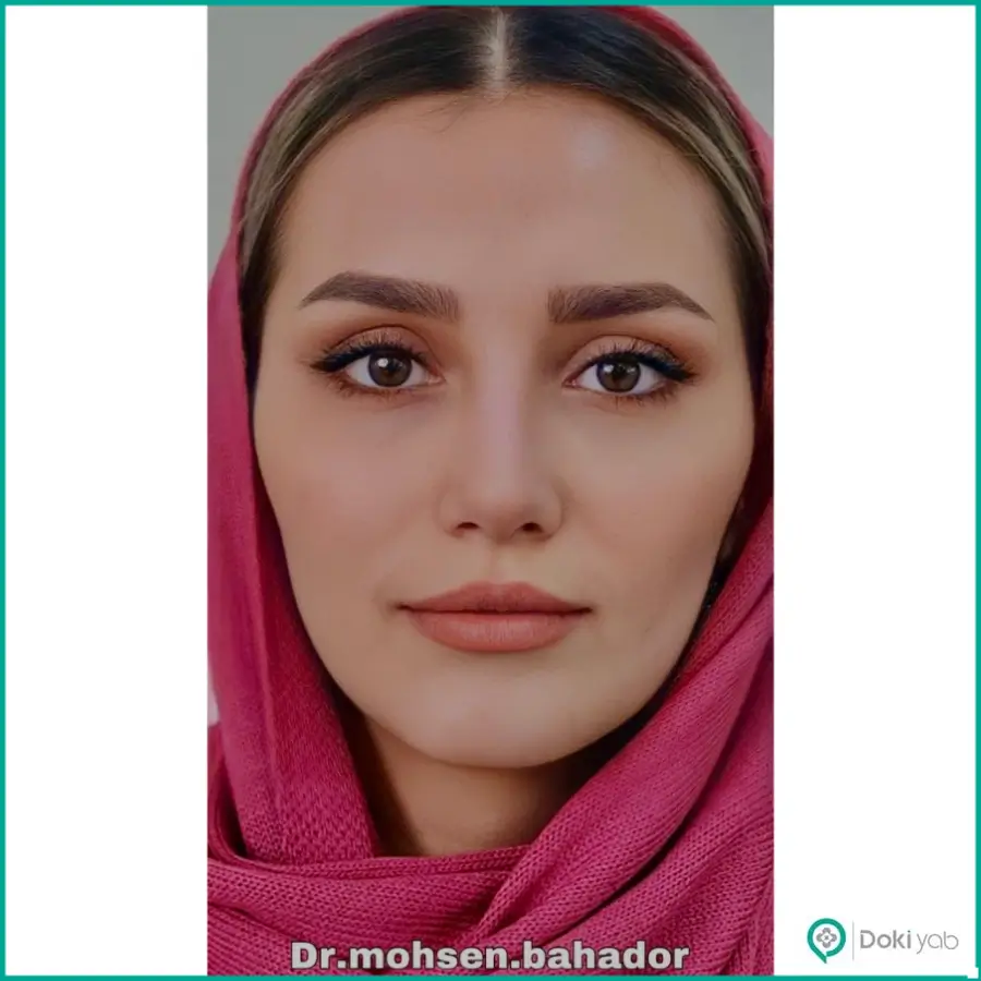 نمونه کار جراح بینی سبک طبیعی در شیراز