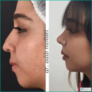 عکس قبل و بعد عمل بینی استخوانی به سبک نیمه فانتزی دکتر ادیب ملائی در شیراز