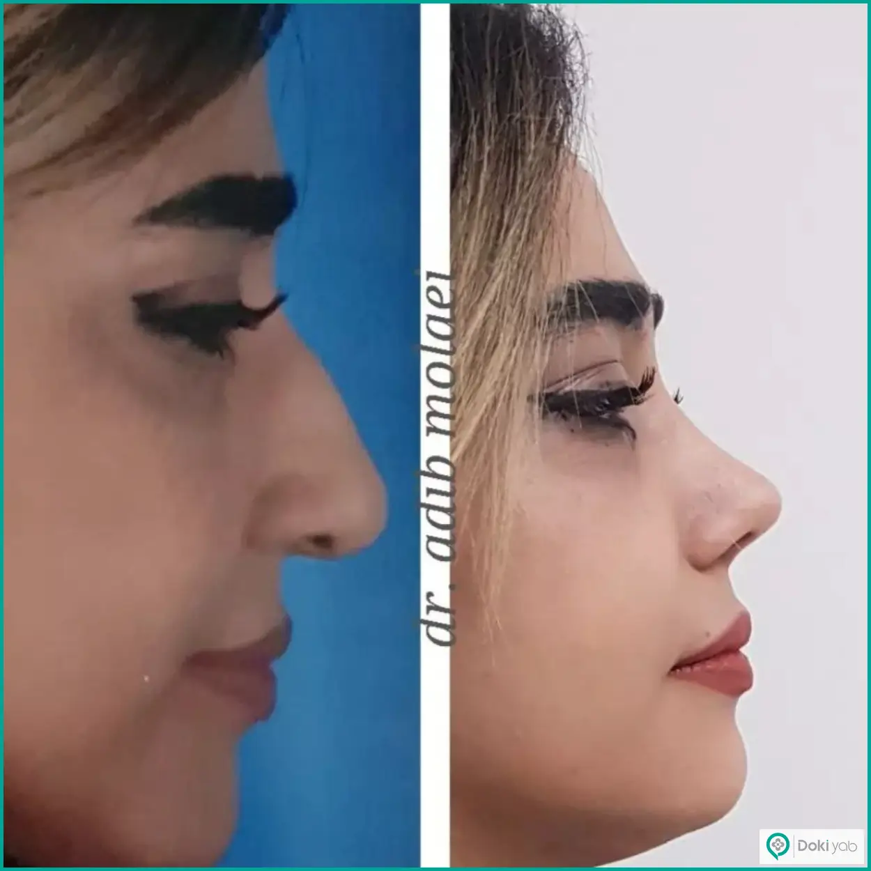 عکس قبل و بعد عمل بینی استخوانی به سبک نیمه فانتزی دکتر ادیب ملائی جراح بینی در شیراز