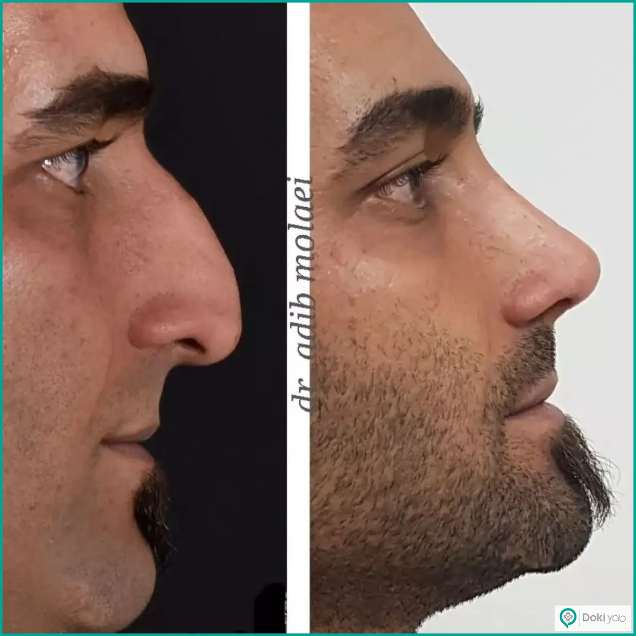 عکس قبل و بعد عمل بینی استخوانی به سبک طبیعی دکتر ادیب ملائی در شیراز