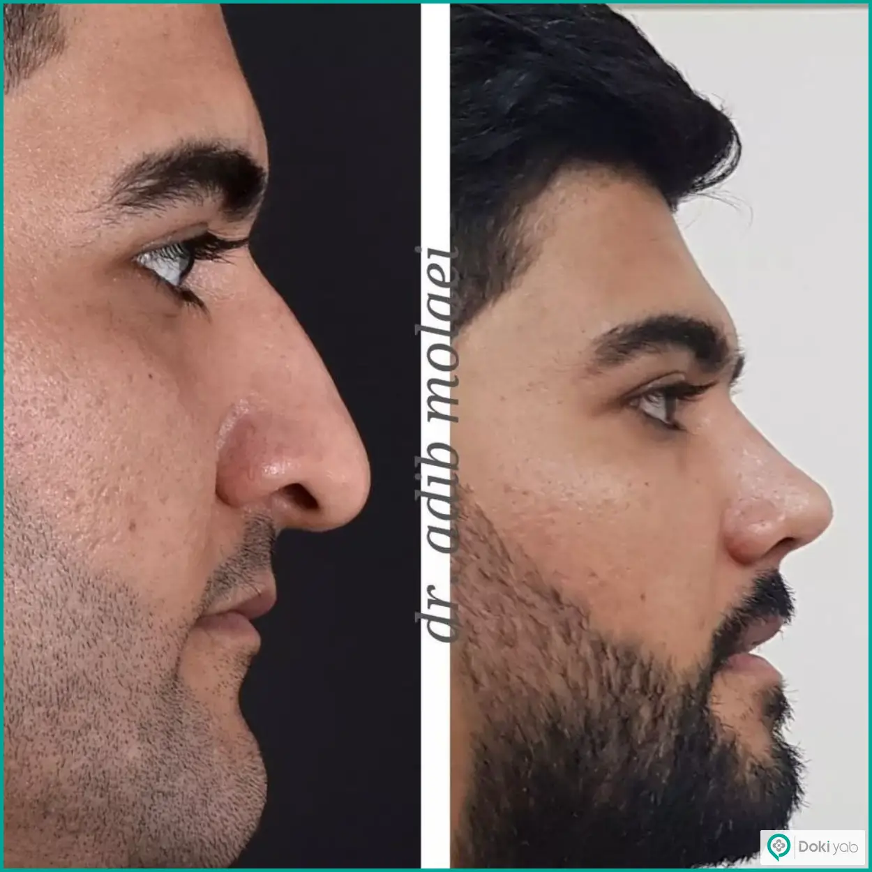 تصویر قبل و بعد عمل بینی استخوانی به سبک طبیعی دکتر ادیب ملائی در شیراز
