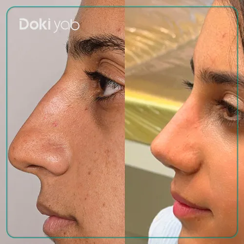 نمونه جراحی زیبایی بینی استخوانی دکتر نفیسه محمودی