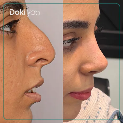 نمونه کار عمل بینی دکتر نفیسه محمودی