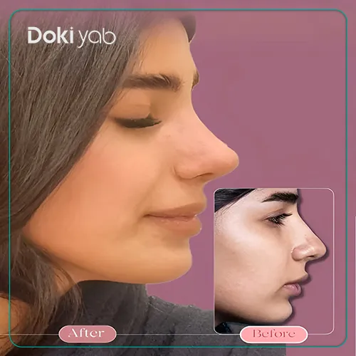 عکس قبل و بعد عمل دماغ استخوانی دکتر نرگس رزم آرا