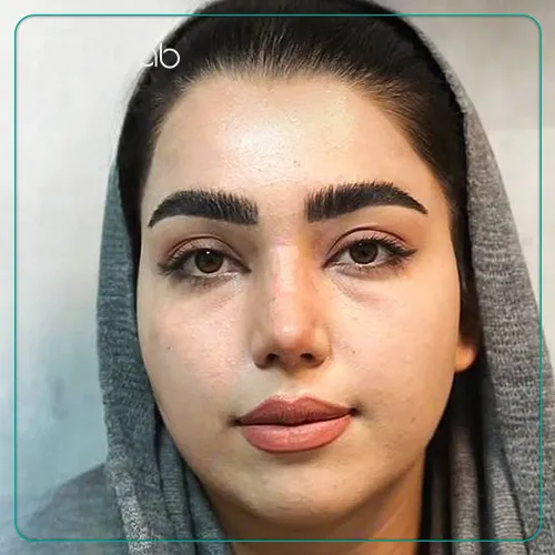 نمونه جراحی بینی با دکتر نگار جعفری در شیراز