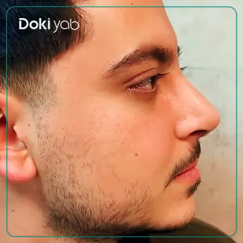 نمونه کار جراحی بینی دکتر نگار جعفری در شیراز