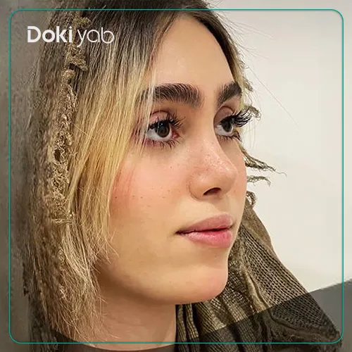 نمونه عمل جراحی بینی دکتر پیام حق پناه شیراز