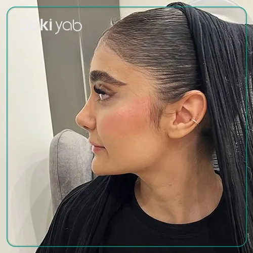 عکس نمونه کار جراحی بینی با دکتر پیام حق پناه در شیراز