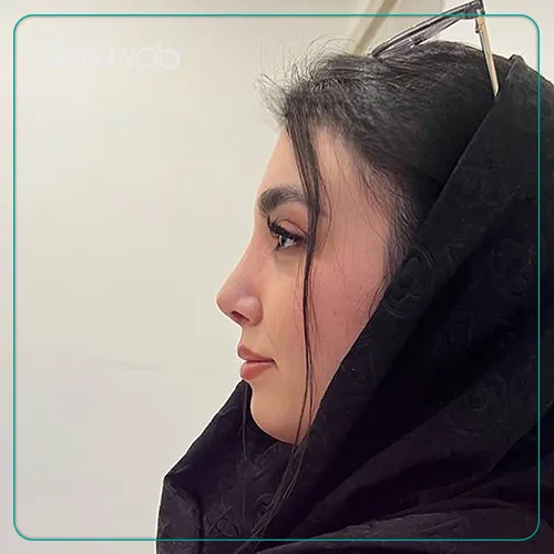 نمونه کار جراحی بینی دکتر پیام حق پناه در شیراز