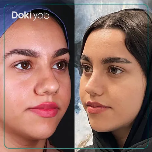 نمونه کار جراحی بینی دکتر سلمان شاکری در شیراز