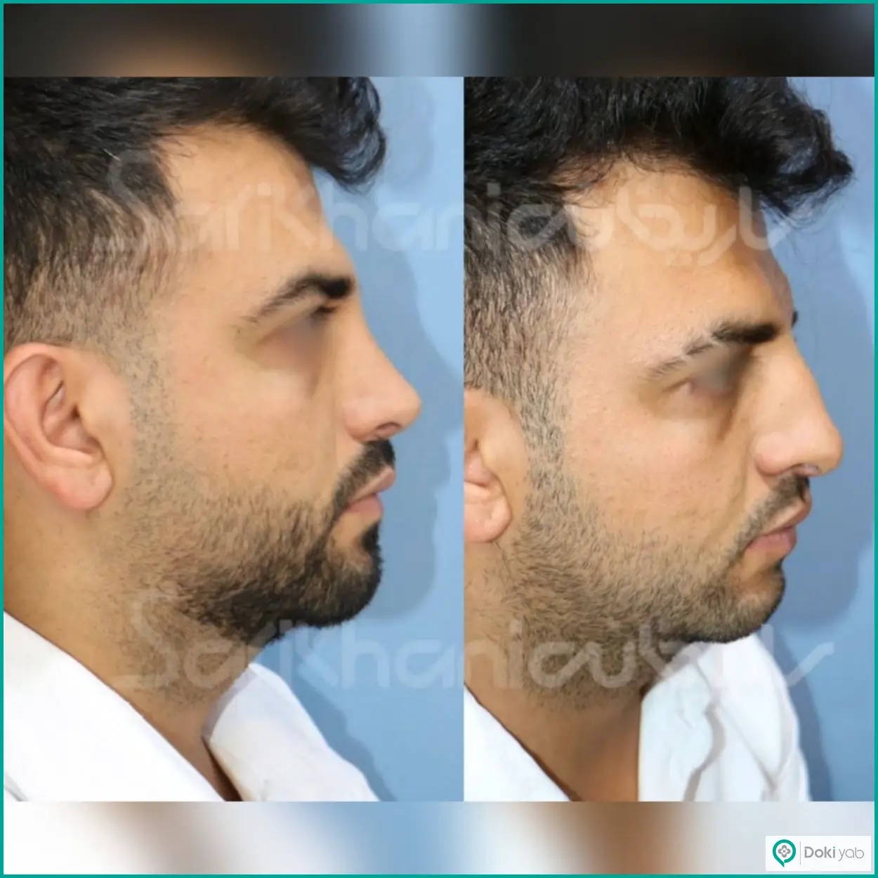 عکس قبل و بعد عمل بینی استخوانی مردانه دکتر داریوش ساریخانی جراح بینی در شیراز