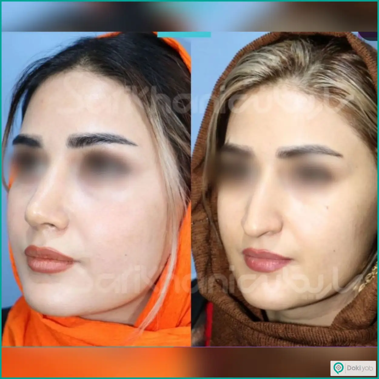 نمونه عکس قبل و بعد عمل بینی استخوانی طبیعی دکتر داریوش ساریخانی جراح بینی در شیراز