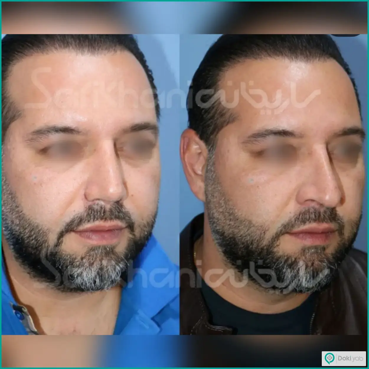 عکس قبل و بعد عمل بینی استخوانی به روش طبیعی مردانه دکتر داریوش ساریخانی جراح بینی در شیراز