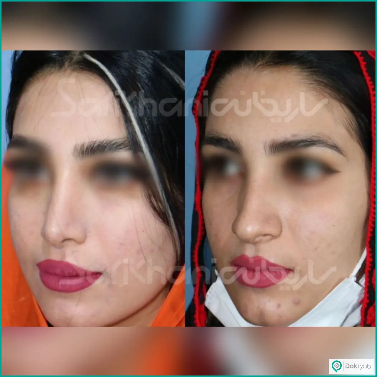 نمونه عکس قبل و بعد عمل بینی طبیعی دکتر داریوش ساریخانی جراح بینی در شیراز
