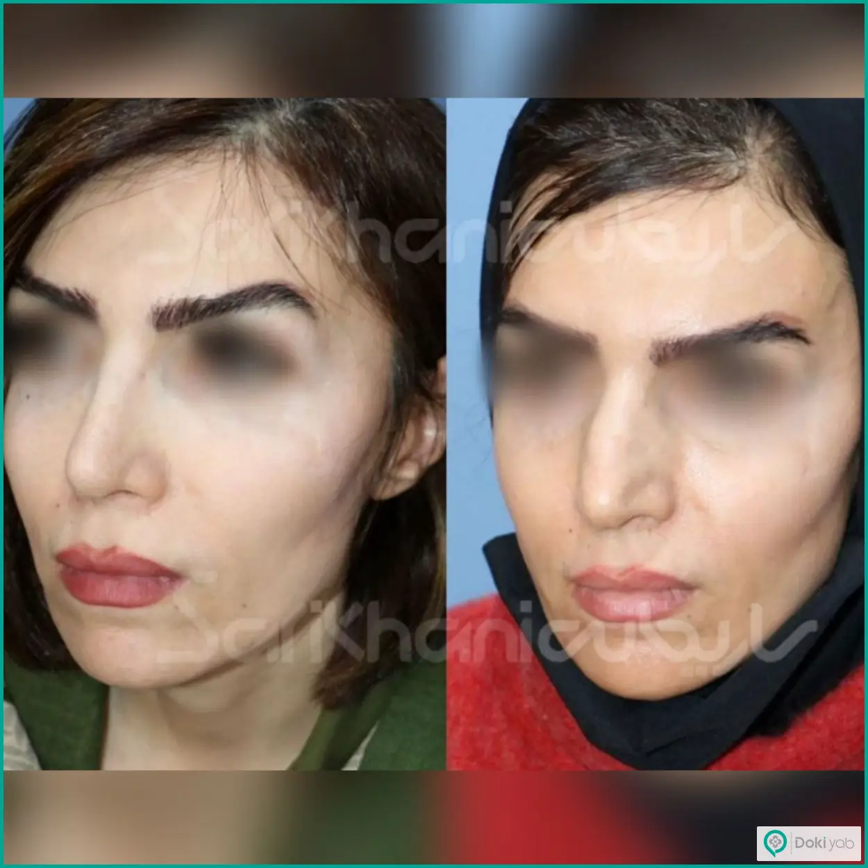 عکس قبل و بعد عمل بینی استخوانی به روش طبیعی دکتر داریوش ساریخانی جراح بینی در شیراز