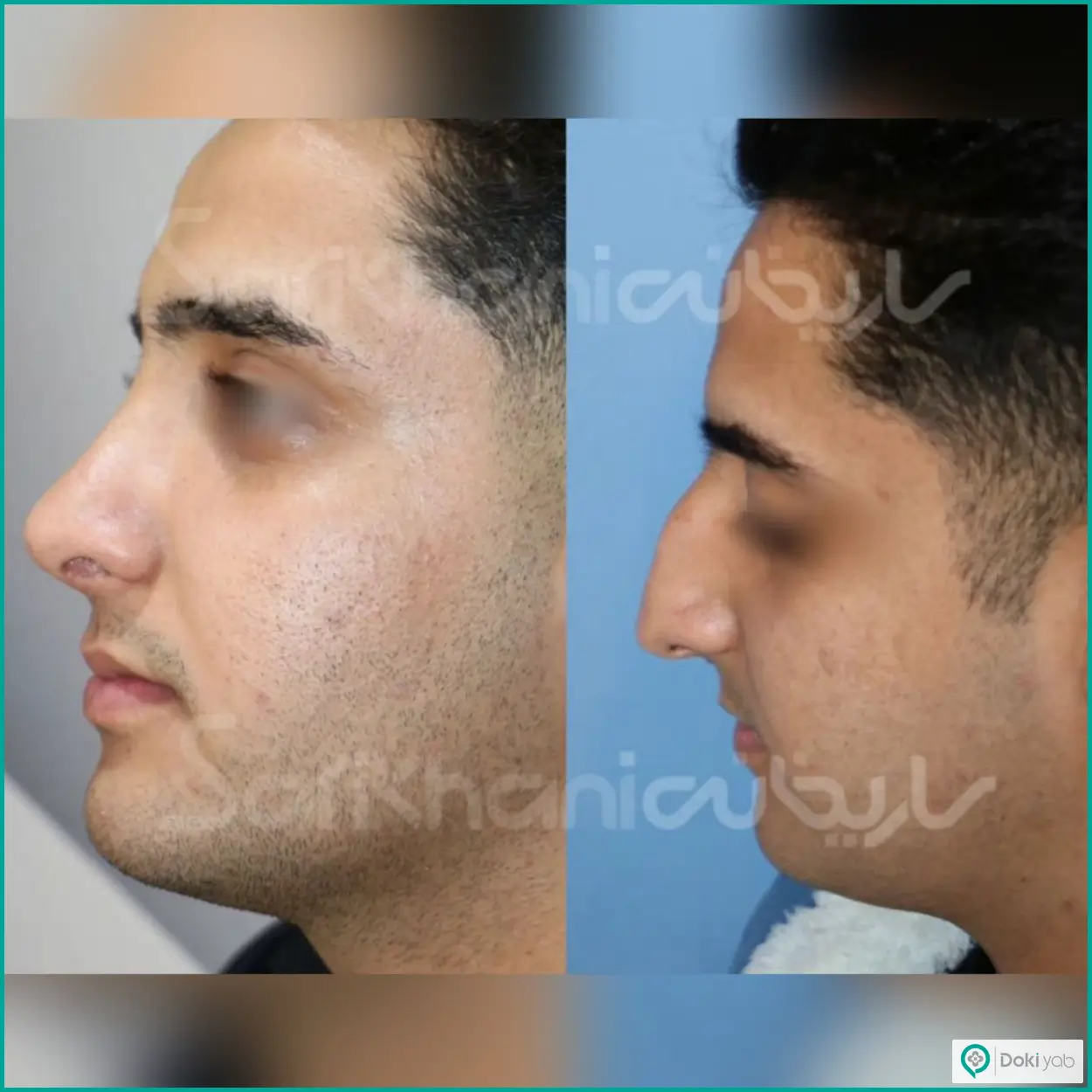 عکس قبل و بعد عمل بینی استخوانی به سبک طبیعی دکتر داریوش ساریخانی جراح بینی در شیراز