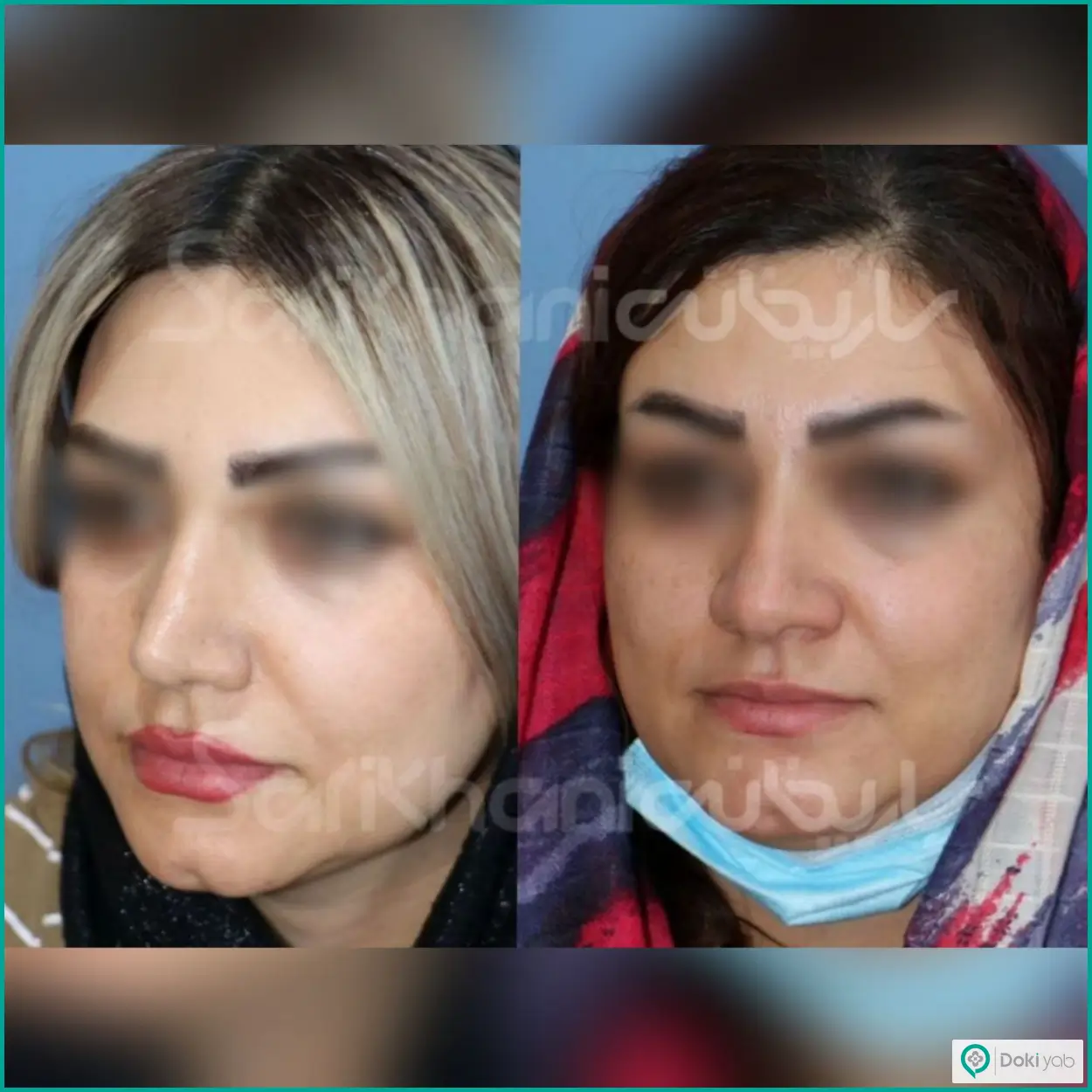 تصویر قبل و بعد عمل بینی استخوانی دکتر داریوش ساریخانی جراح بینی در شیراز