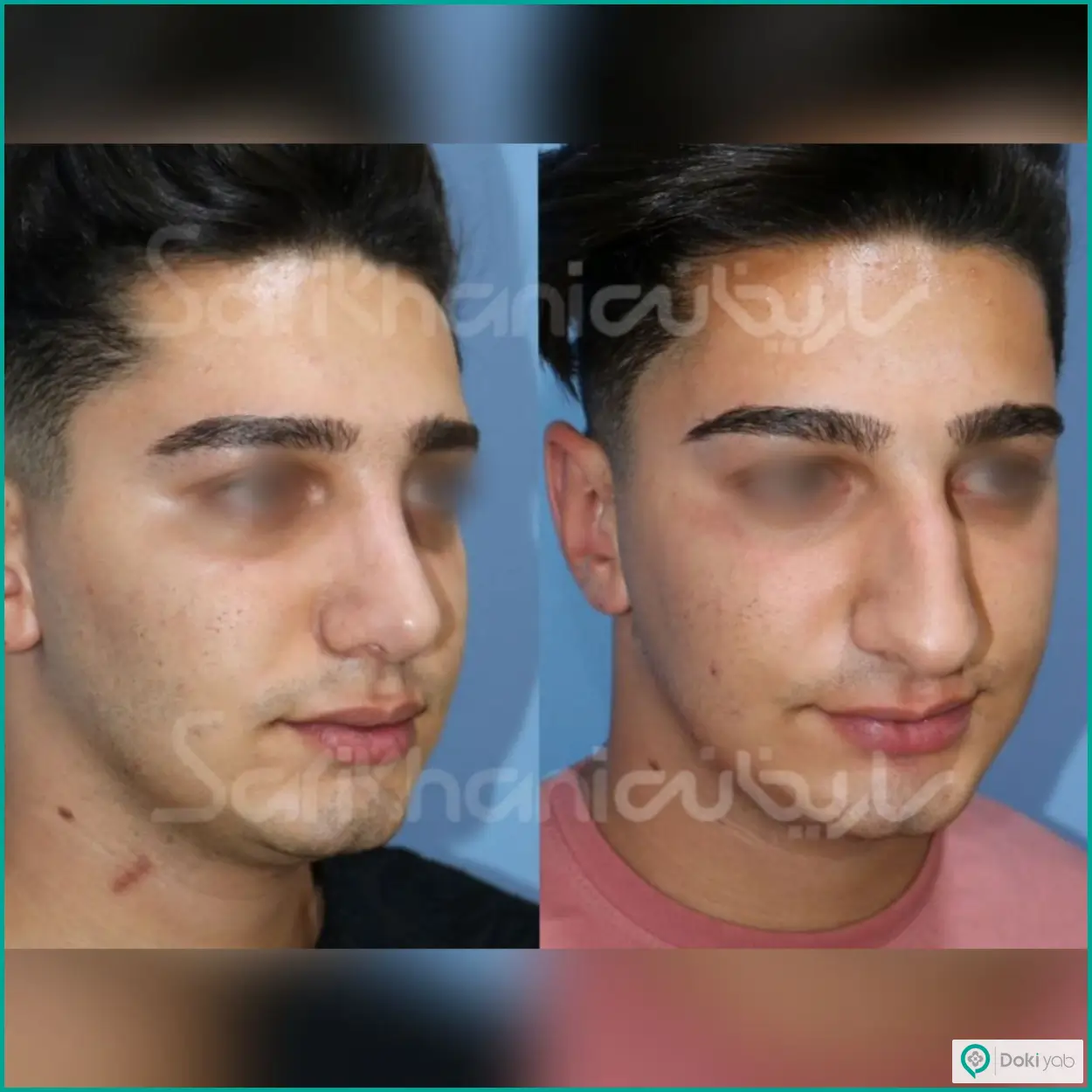 تصویر قبل و بعد جراحی بینی استخوانی دکتر داریوش ساریخانی جراح بینی در شیراز