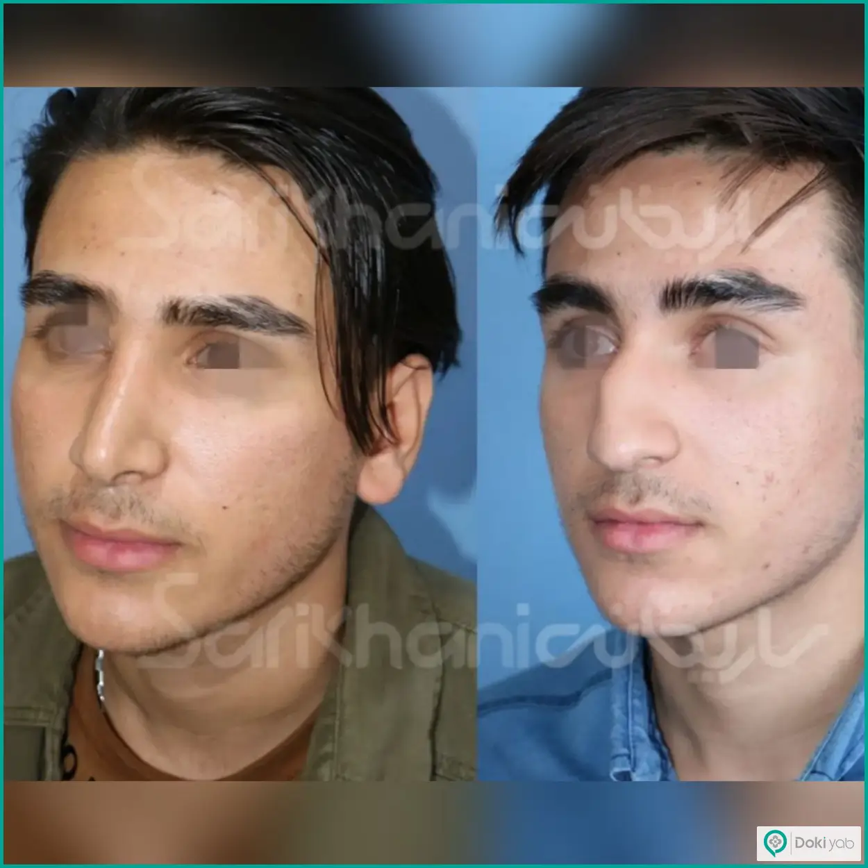 عکس قبل و بعد عمل بینی استخوانی دکتر داریوش ساریخانی جراح بینی در شیراز