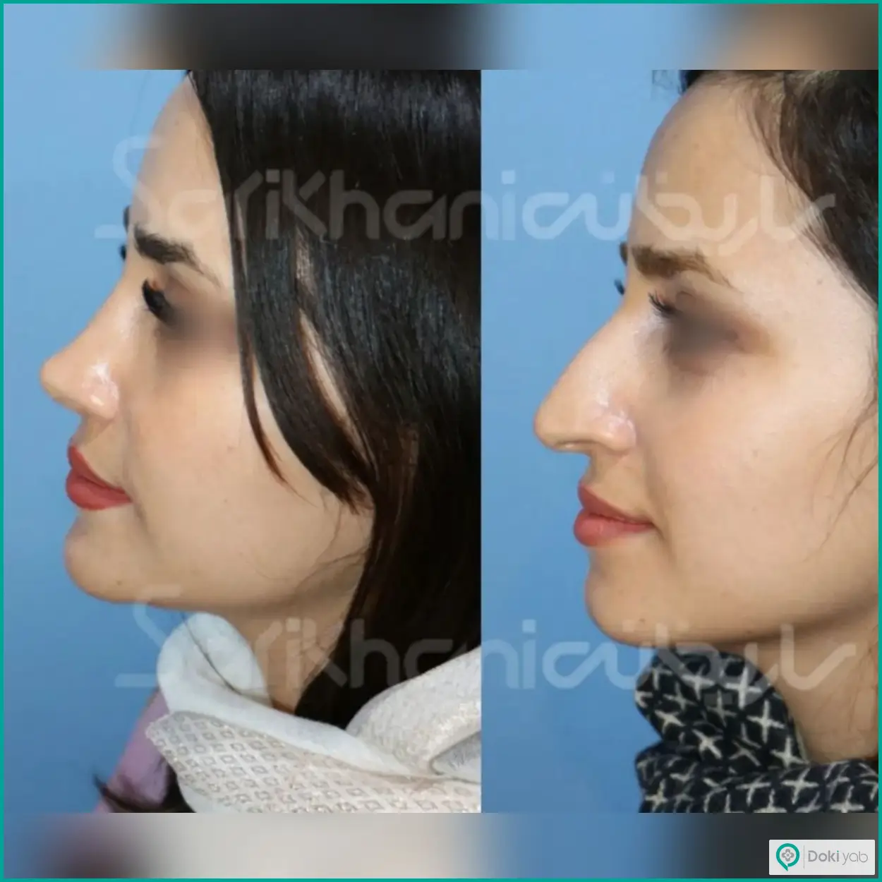 عکس قبل و بعد عمل بینی استخوانی دکتر داریوش ساریخانی جراح بینی در شیراز