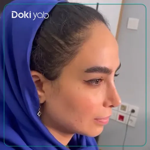 تصویر عمل جراحی بینی با دکتر شاه مرادی شیراز