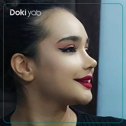 نمونه کار عمل بینی دخترانه شیک در شیراز توسط دکتر آصفی - تناسب کامل با چهره