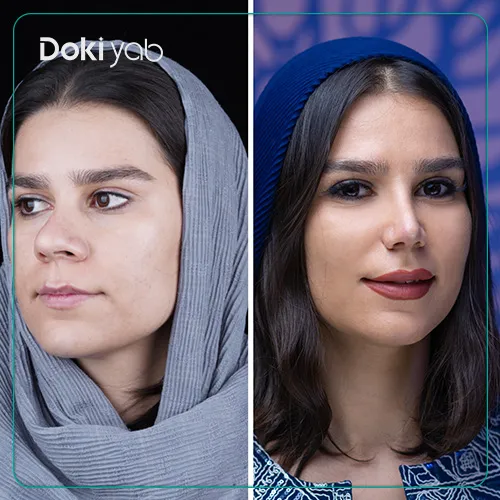 نمونه‌کار جراحی بینی گوشتی با مشاوره مجموعه دکی یاب در شیراز