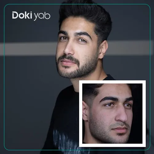 عکس عمل بینی گوشتی در شیراز با افتادگی نوک بینی؛ دکی یاب