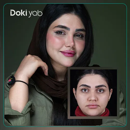 نمونه کار بهترین دکتر عمل بینی گوشتی در شیراز؛ دکی یاب