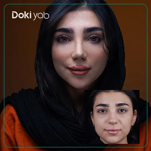 تصویر تمام‌رخ عمل با بهترین جراج بینی گوشتی شیراز در دکی یاب