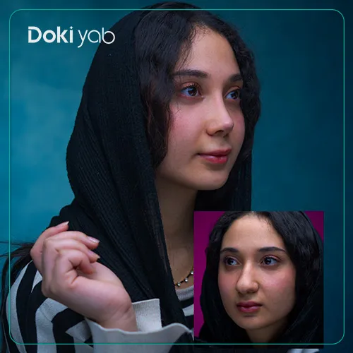 عکس قبل و بعد عمل بینی گوشتی شیراز با مشاوره دکی یاب