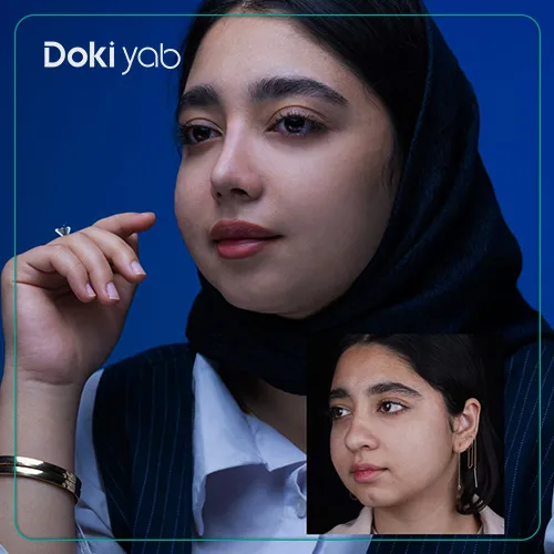 نمونه عمل با بهترین جراح بینی گوشتی در شیراز؛ دکی یاب