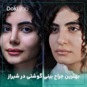 معرفی بهترین جراحان بینی گوشتی؛ مجموعه دکی یاب