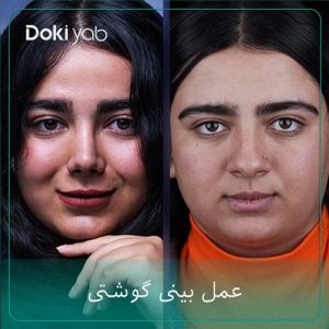 عمل بینی گوشتی