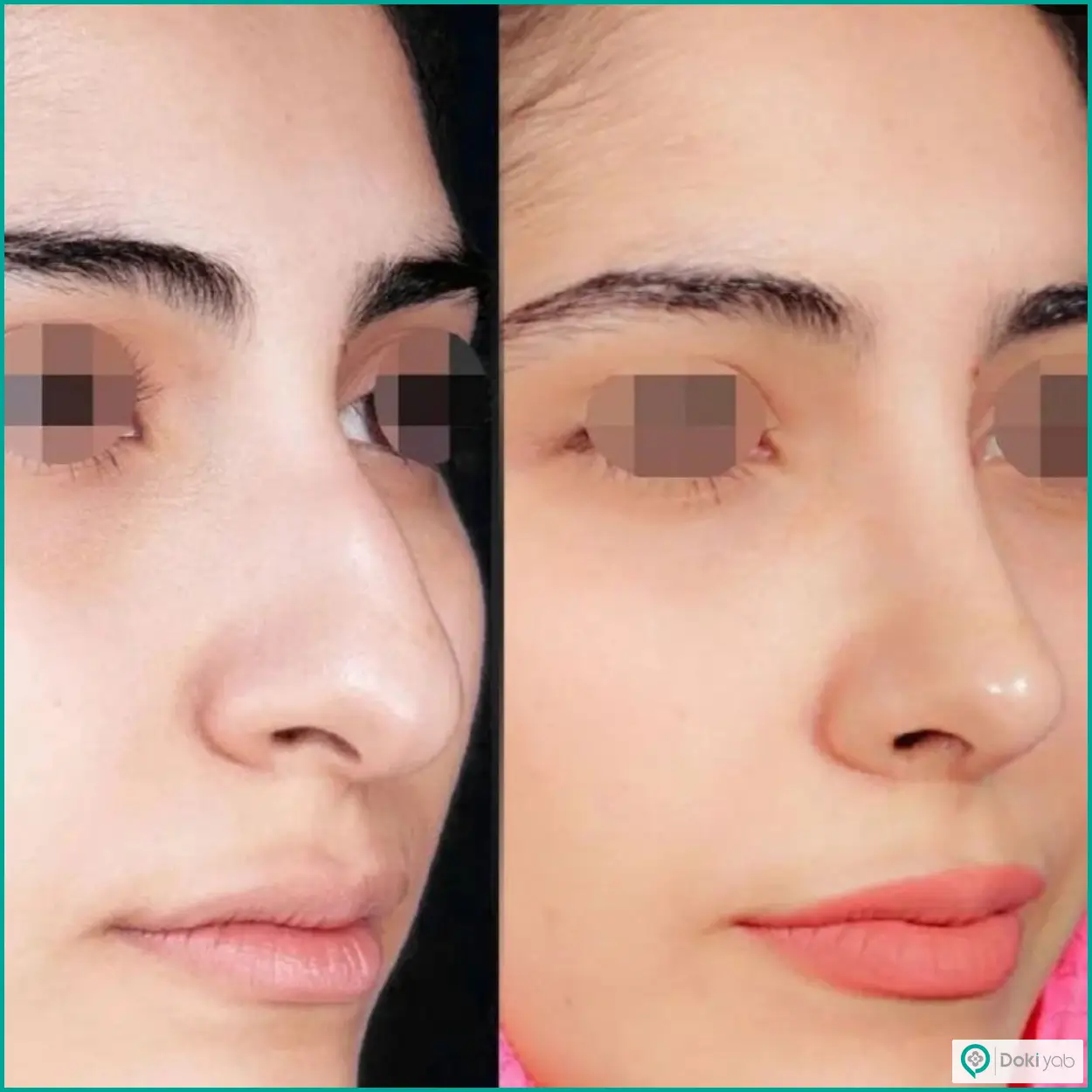 نمونه عکس قبل و بعد عمل بینی استخوانی طبیعی دکتر محسن روشنی