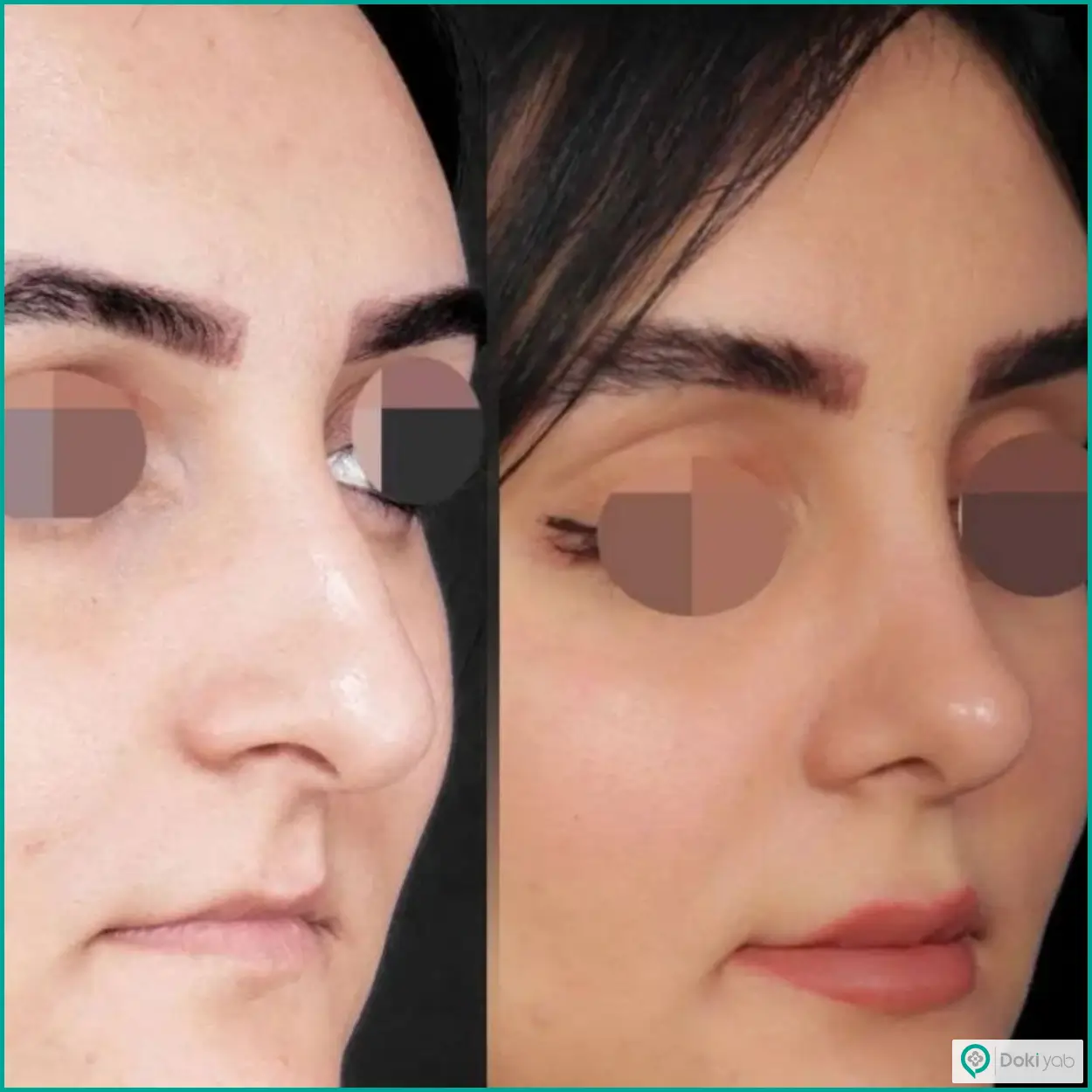 تصویر قبل و بعد عمل زیبایی بینی دکتر محسن روشنی