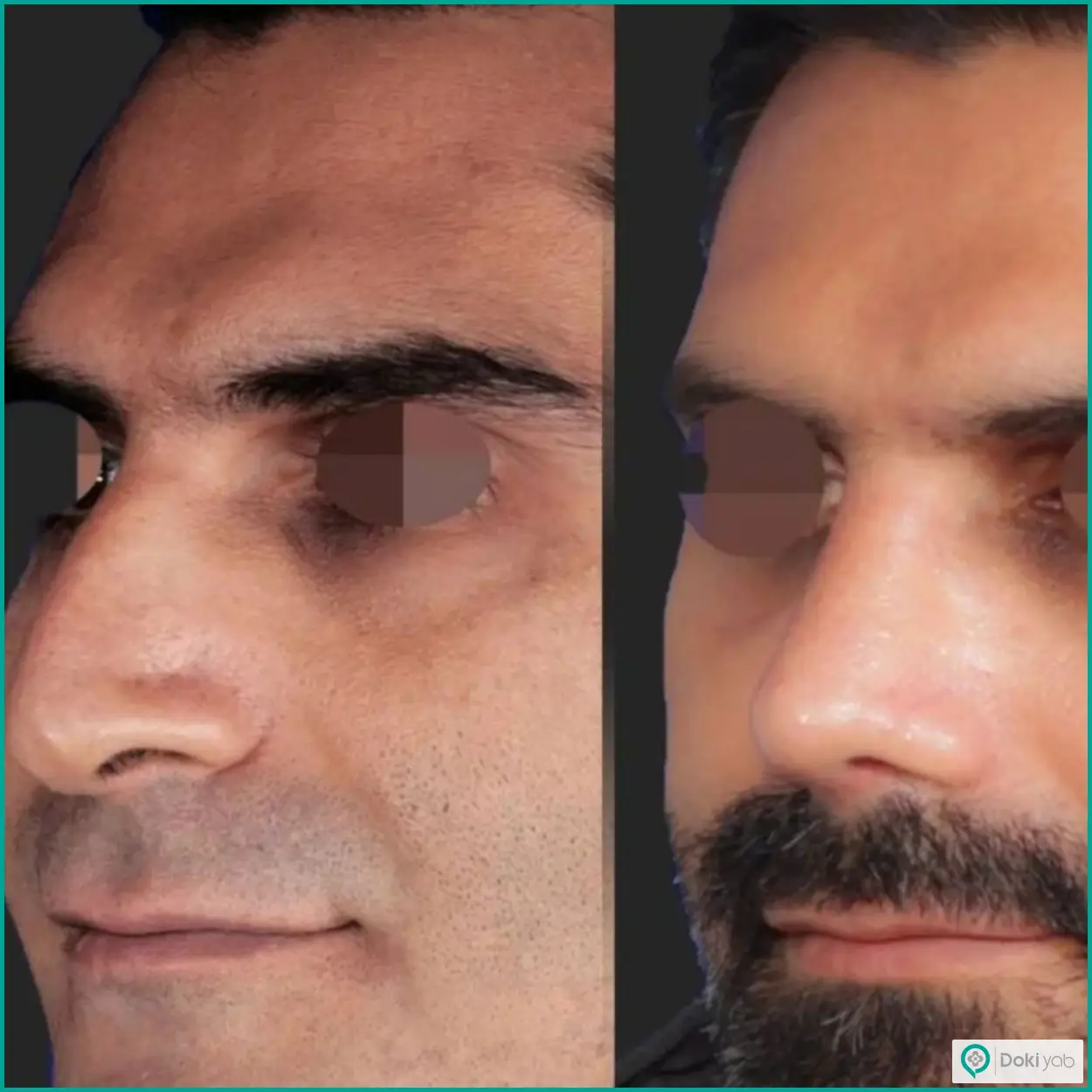 نمونه عمل بینی طبیعی مردانه دکتر محسن روشنی