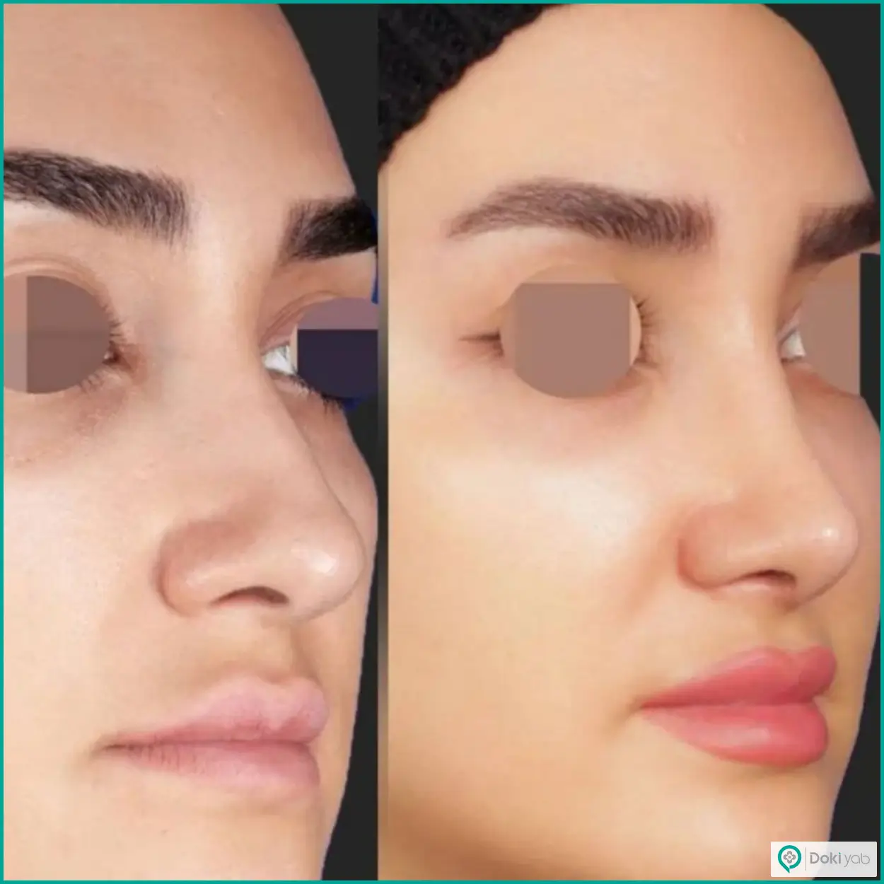نمونه جراحی بینی طبیعی دکتر محسن روشنی