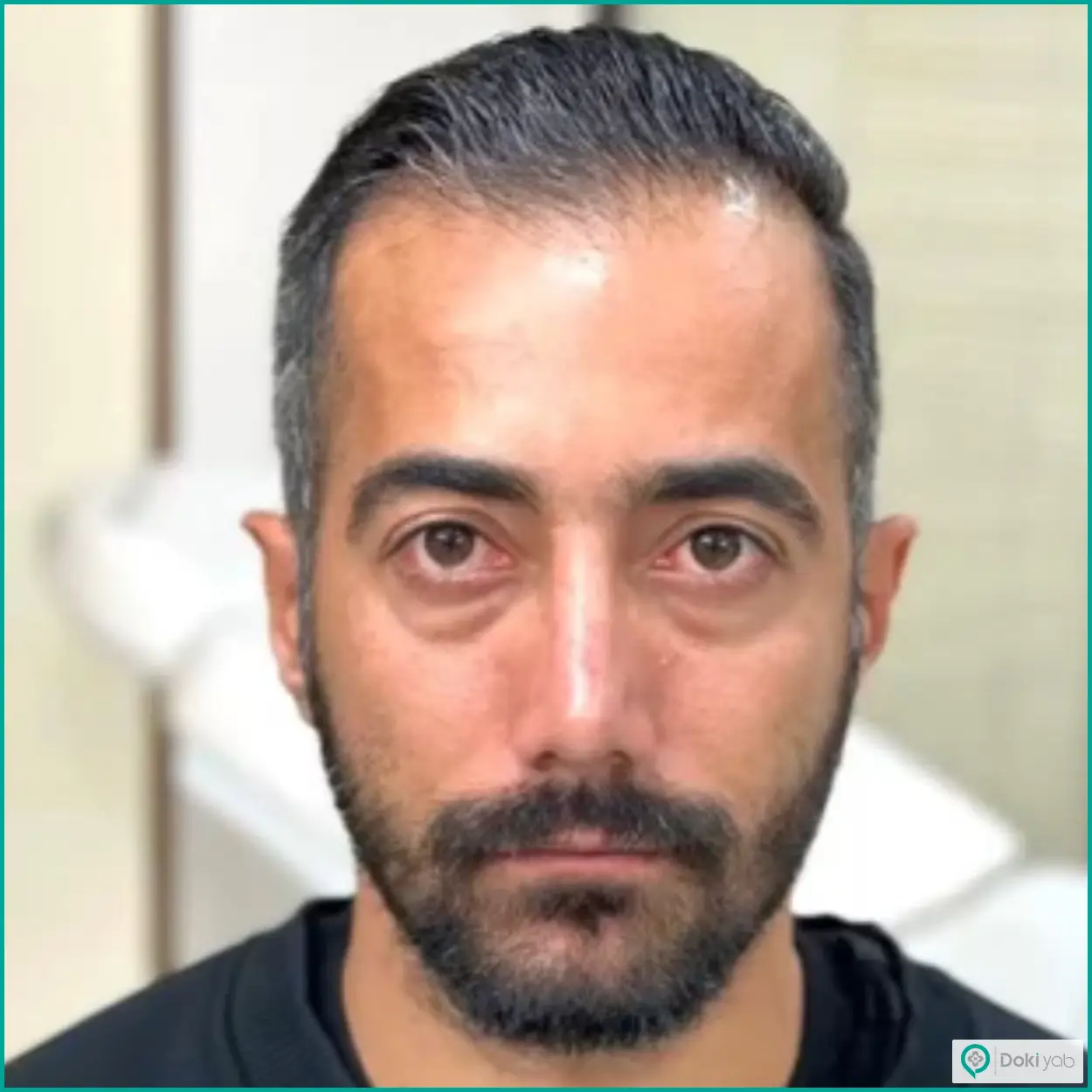 نمونه عمل بینی طبیعی مردانه دکتر آمیتیس نوذری جراح بینی شیراز