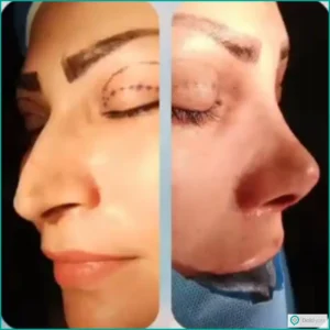 تصویر قبل و بعد عمل بینی استخوانی به سبک نیمه فانتزی دکتر محمدمهدی مهرابی